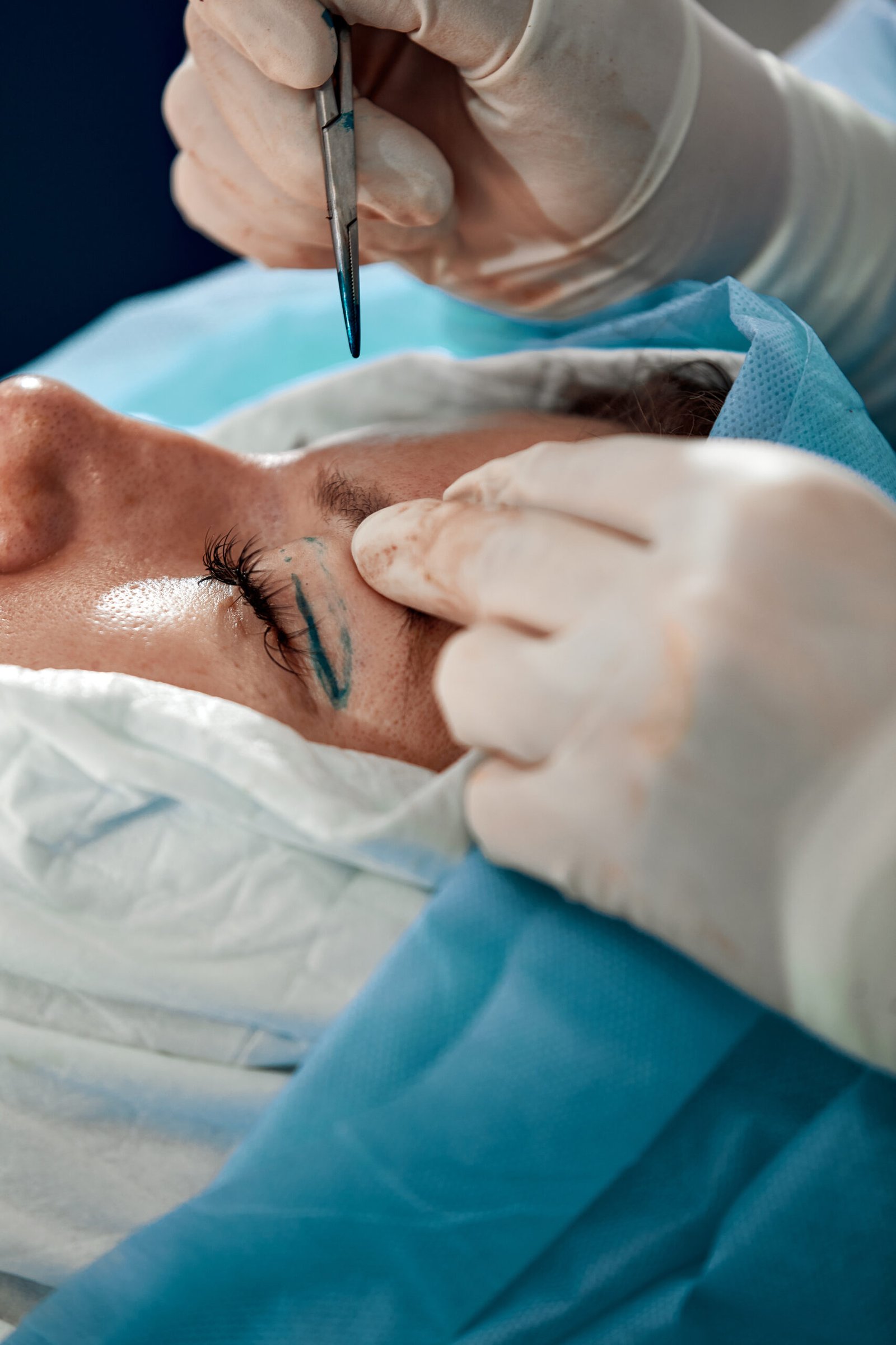 close up of the face of a patient undergoing blepharoplasty. the surgeon cuts the eyelid and performs manipulations using medical instruments